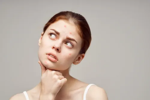 Read more about the article Jak pielęgnować skórę trądzikową?